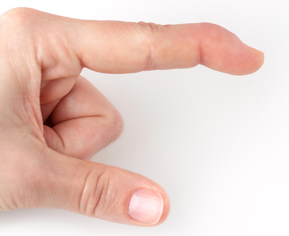 mallet-finger-side